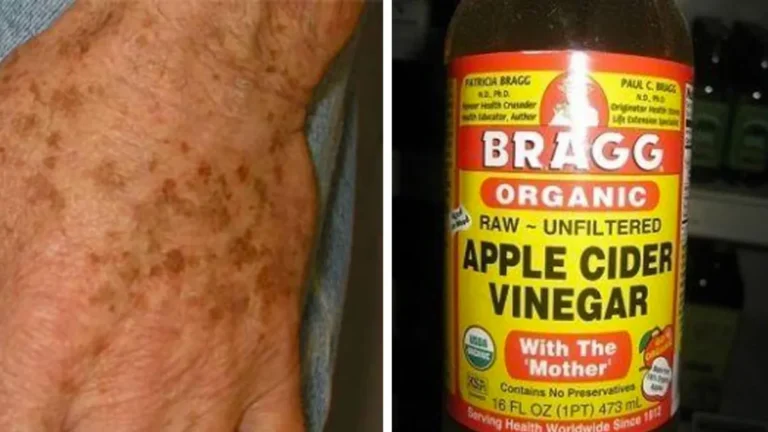 “How to Fade Age Spots Naturally with Apple Cider Vinegar  It Really Works